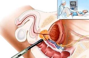 formas de diagnosticar la prostatitis