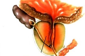 que es la prostatitis en los hombres