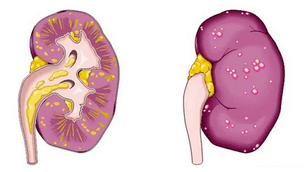 que causa la prostatitis aguda