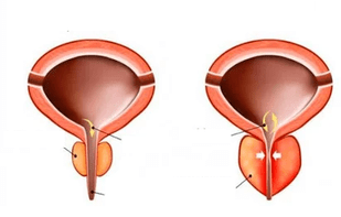 que es la prostatitis aguda