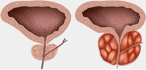 que es la prostatitis