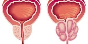 la prostatitis