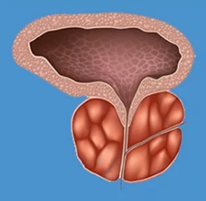 Algunos de los signos característicos de la prostatitis
