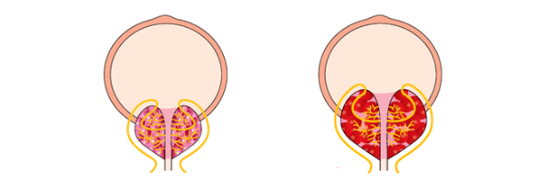 próstata sana e inflamada con prostatitis