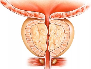 La prostatitis