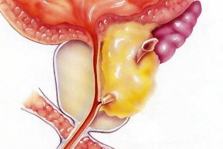 la prostatitis