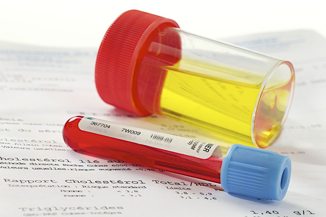Un análisis de sangre y orina ayudará a determinar la presencia de prostatitis.
