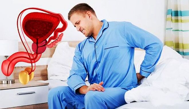 dolor lumbar debido a prostatitis