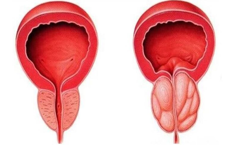 próstata sana e inflamada con prostatitis